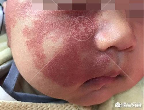新生儿红斑和鲜红斑痣你分得清吗