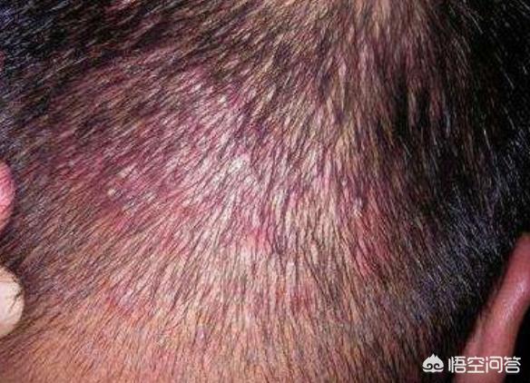 头皮上的毛囊炎，是什么原因引起的？