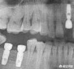 种植牙全口假牙多少钱？