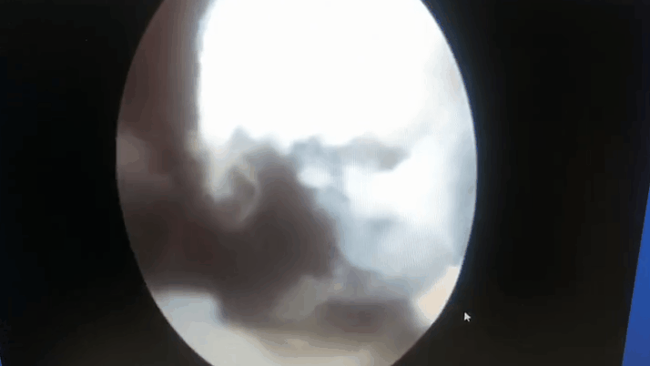 患了骨性关节炎怎么治疗:关节坏了，走不动路了怎么办？骨关节炎吃药还是手术好？