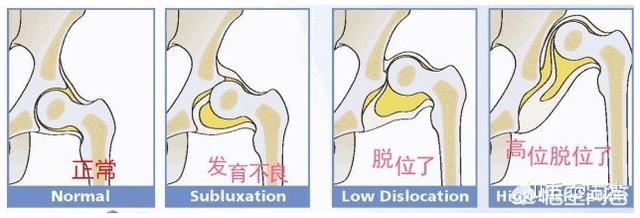 胯关节发育不良:什么是成人髋关节发育不良？