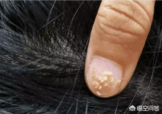 人感染了猫疥螨怎么办:上万只螨虫天天在脸上打洞，该如何去除？