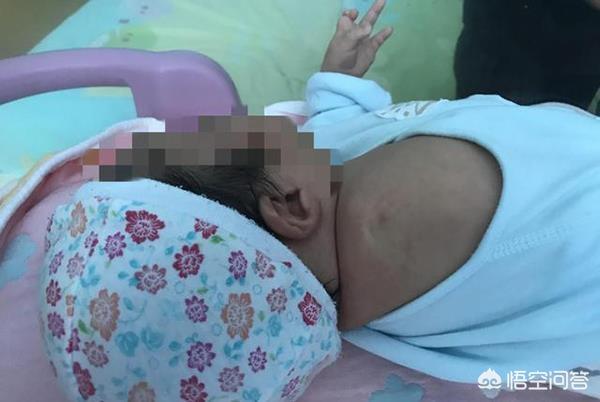 独眼畸形婴儿:产检正常，却生下畸形儿，到底怎么回事