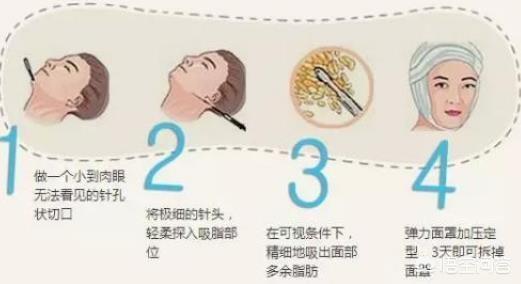 脸型发腮是什么意思:哪些方法可以改善下颌变宽发腮？