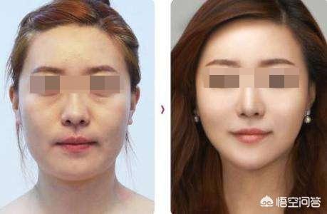 雷达线雕的原理及功效,线雕是什么？和玻尿酸一样吗？