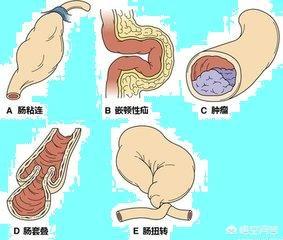 宝宝肠梗塞是怎么引起的:出生婴儿肠梗阻是怎么回事？