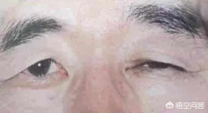 希思黎瞬间紧致眼膜:眼皮皮肤松弛下垂了怎么办？