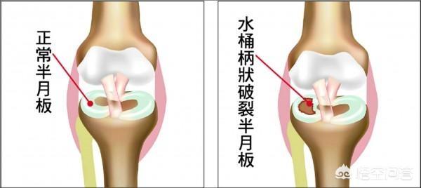 腿响是怎么回事:膝关节响是怎么回事？是膝关节炎吗？