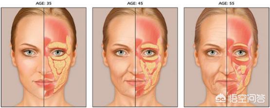 自体脂肪填充太阳穴能让额头变宽吗？