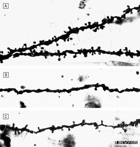怎么样造成的精神分裂症,精神分裂症与睡眠有什么关系？