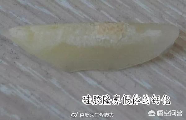 假体隆鼻后注意事项(假体隆鼻后注意的事项)