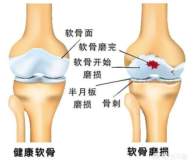 腿响是怎么回事:膝关节响是怎么回事？是膝关节炎吗？