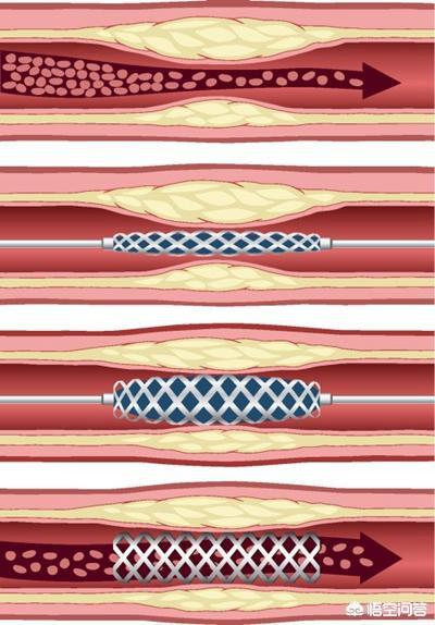 支架手术后注意事项(什么情况下可以安装心脏支架)，什么情况需要做心脏支架？