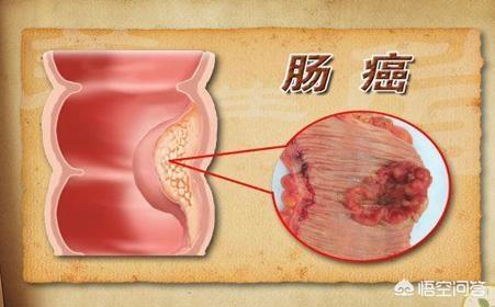 预防肠道疾病教学设计:怎么预防肠道疾病 看新闻又一个年轻人因肠癌离世，肠癌怎么这么可怕，可以预防吗？