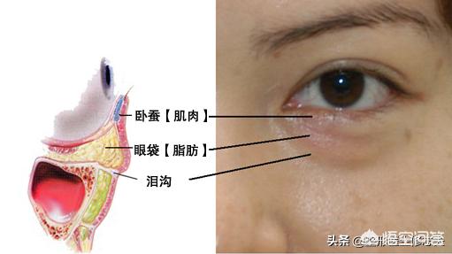 眼袋怎样消除?眼袋怎样消除最有效的方法