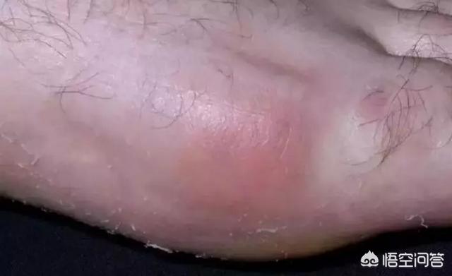 符晓薇:痛风“祸根”找到了，医生说：有3种食物要尽快远离，具体指什么