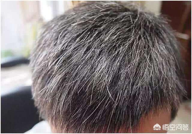 长白头发是身体缺少什么吗？