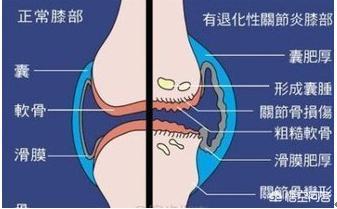 骨包虫骨质破坏图片:为什么说骨髓炎不疼不痒，也要当心癌变，截肢呢？