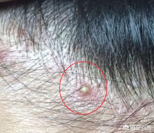 螨虫叮咬症状:宝宝身上被螨虫咬的好多痘痘，该怎么办？