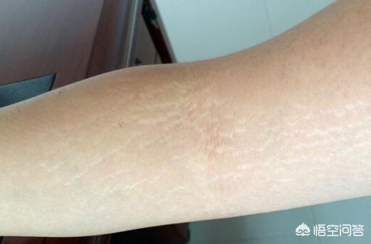 女朋友身上有妊娠纹,但是她说她没生过孩子,有这种情况吗?-惠修网