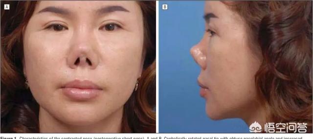 拥有一对猪鼻子(朝天鼻)是一种什么样的体验,第5张