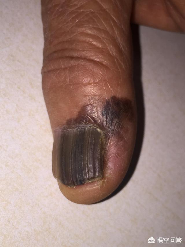 脚指甲变黑为什么?