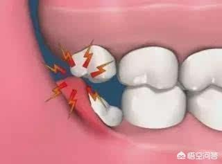 拔智齿到底有多痛？大概费用是多少？