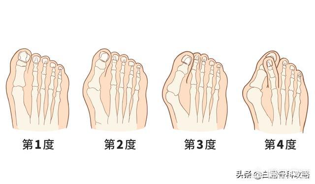 头条问答 - 拇外翻使用矫正器来进行矫正的话是不是会好很多?