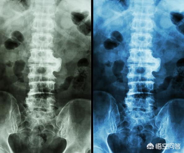 强直性脊柱炎怎么判断几期 强直性脊柱炎2020年可治愈 强直性脊柱炎患者应该怎么治疗