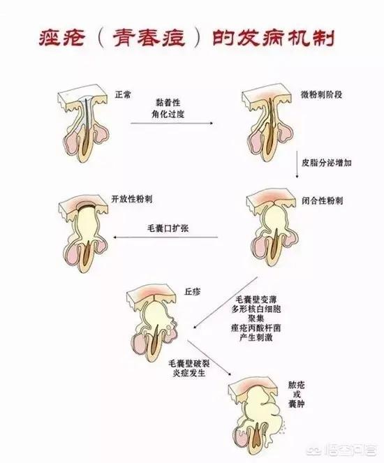 痘痘和痤疮的区别图片,脸上痘痘特别密集是痤疮吗？