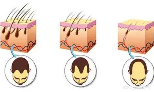 头条问答 为什么一个毛囊里会长两三根毛 8个回答