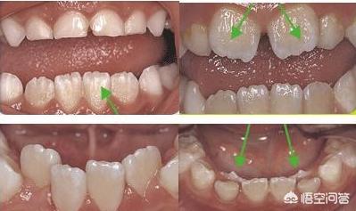 头条问答 7岁女童上门牙长歪 是现在订做牙套好还是等牙齿换完带牙套好 32个回答