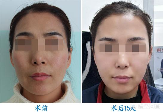 自体脂肪填充太阳穴能让额头变宽吗？