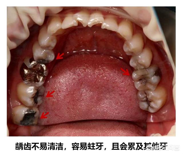 智齿雷米图片