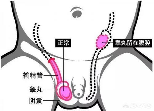 隐睾症图片 真实:隐睾症图片 真实 外观 表现 孩子七岁隐睾手术，可以恢复正常发育吗？