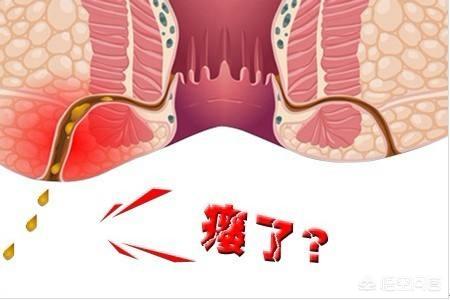 什么是肛门周围癌?-百科网