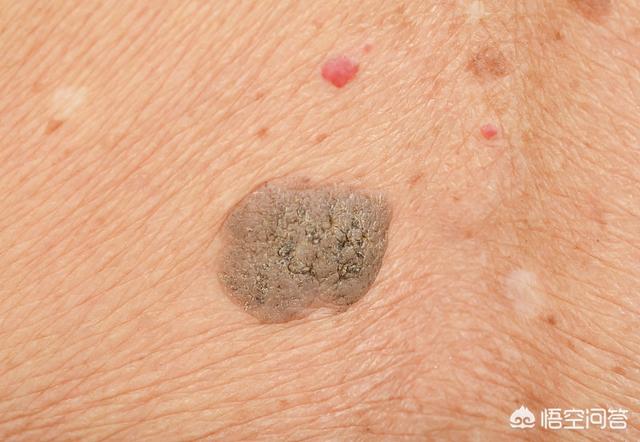 女人私处长什么样图片:女人哪个地方长“疙瘩”，说明身体感染了HPV？