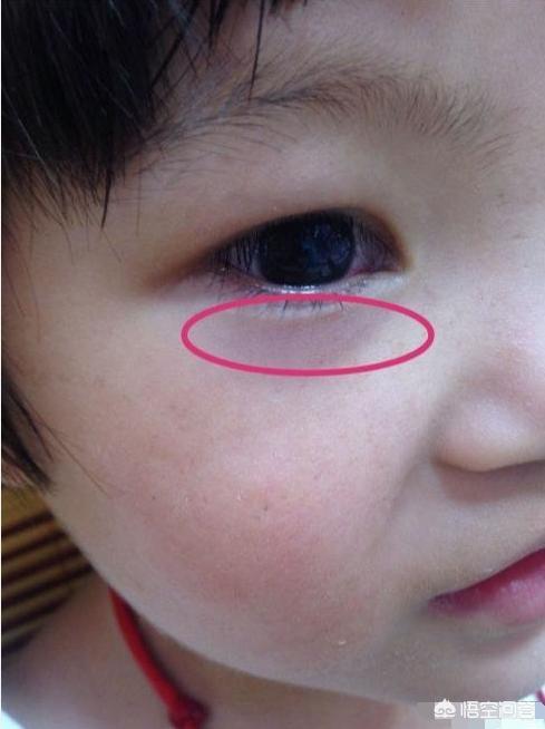 儿童脾虚的症状有哪些