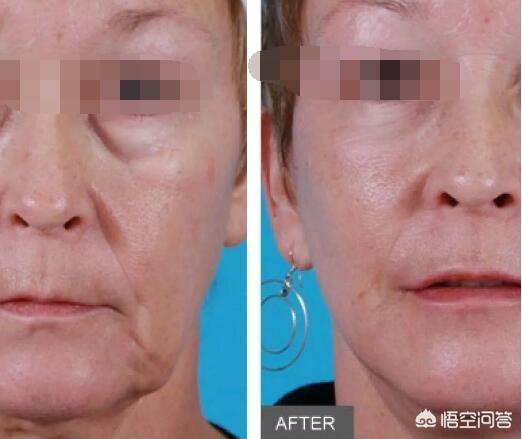 面部除皱新方法(面部提升除皱)