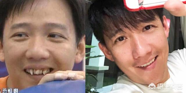 高圆圆整牙前后:整牙真能达到整容效果吗？有什么科学依据？