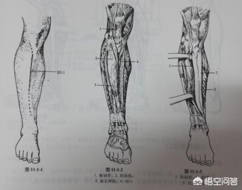 胫腓骨骨折对位对线不佳:小腿粉碎性骨折不做手术，中药保守治疗能好吗？会有什么问题吗？