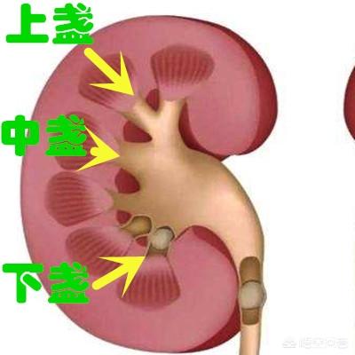 小结石如何排出如何通过调整饮食排出肾结石