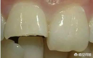 牙齿折断牙根还有用吗:牙齿断了一大半，还有办法修复吗？