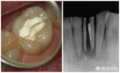 牙齿折断牙根还有用吗:牙齿断了一大半，还有办法修复吗？