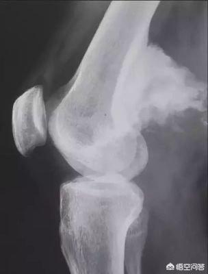什么是骨髓水肿，核磁显示左侧股骨下段局部骨髄水肿，这个水肿是什么原因造成的？