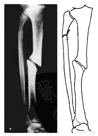 胫腓骨骨折长得慢怎么办:胫腓骨双骨折内固定手术三个月了居然还没长好，什么问题？