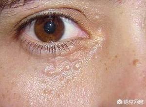 脂肪粒怎么消除在眼睛旁边的:眼周脂肪粒是怎么形成的？如何摆脱眼周脂肪粒的困扰？