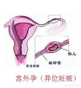 异位妊娠:异位妊娠的临床表现 女孩宫外孕，是男人的错吗？