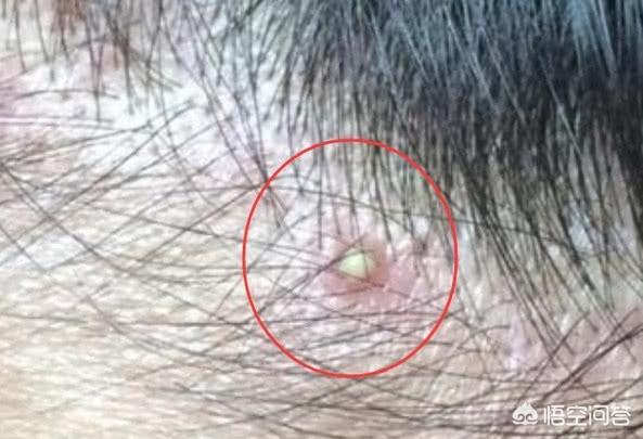 怎么识别毛囊虫:螨虫痘是什么？螨虫痘与普通青春痘的区别在哪里呢？