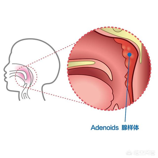 腺样体是位于鼻咽后壁,形状像是扣在鼻咽后壁上的橘子瓣,是咽淋巴环的